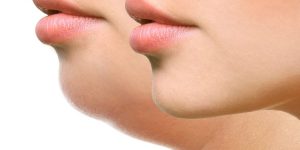lipo-de-papada-enzimatica